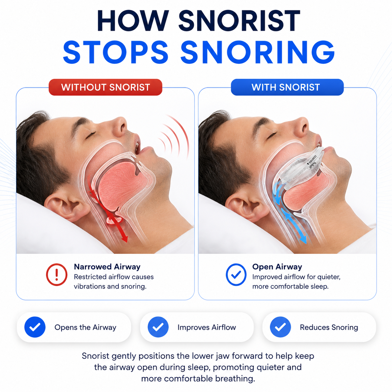 How Snorist stops snoring – airway comparison